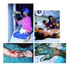Examples of electrical injuries